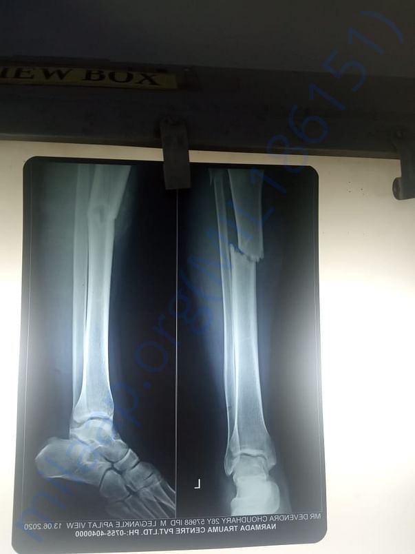 X ray for leg