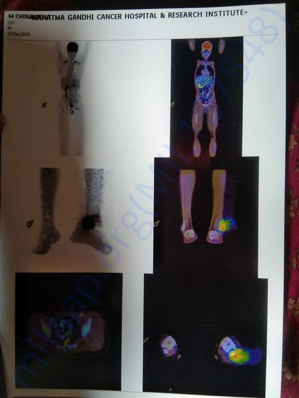 MRI scan