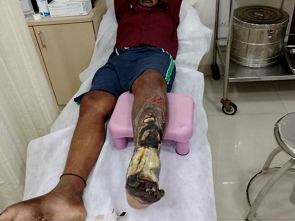 Support Selvaraj G Recover From Leg Infection Due To Sugar
