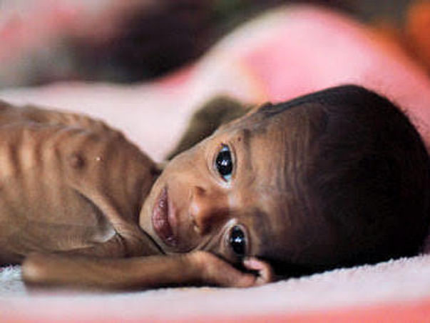 Nutrition for 300 Malnourished children