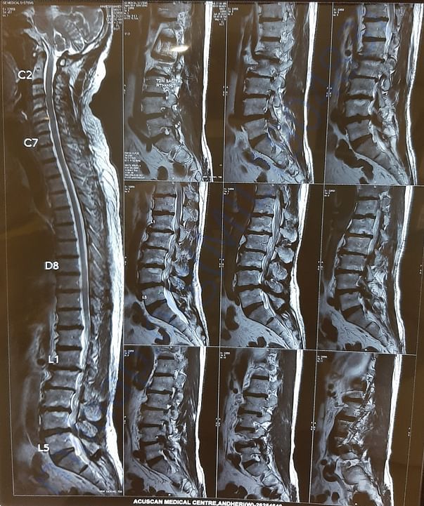 MRI films of spine