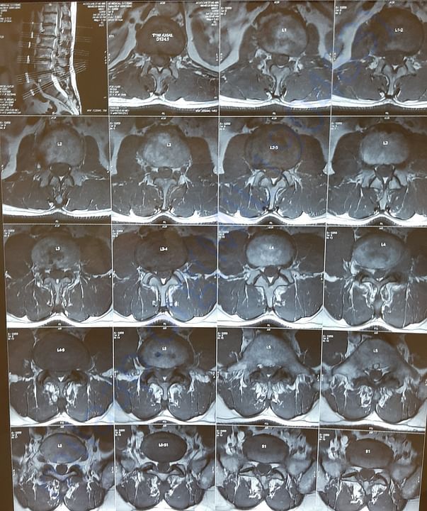 MRI spine