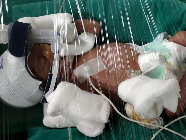 Open Heart Surgery. Twin Babies are born Preterm , Please Help
