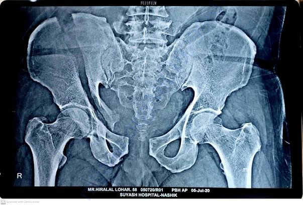 Waist x-ray
