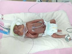 24 Days Old Baby Asna Needs Your Help Fight NICU Care