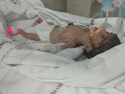 This 26 Weeks Preterm Child Needs Your Support To Survive