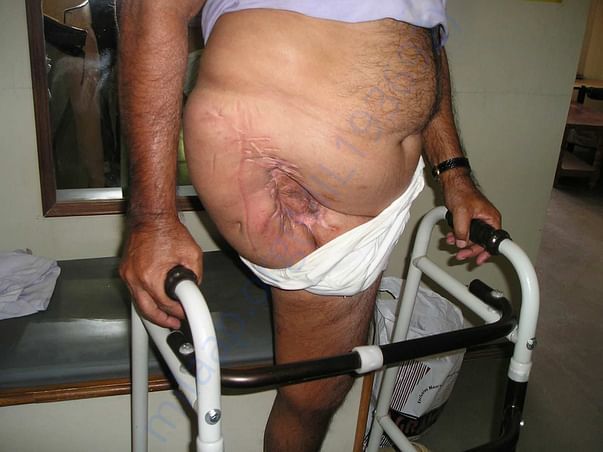 Waiting for prosthesis