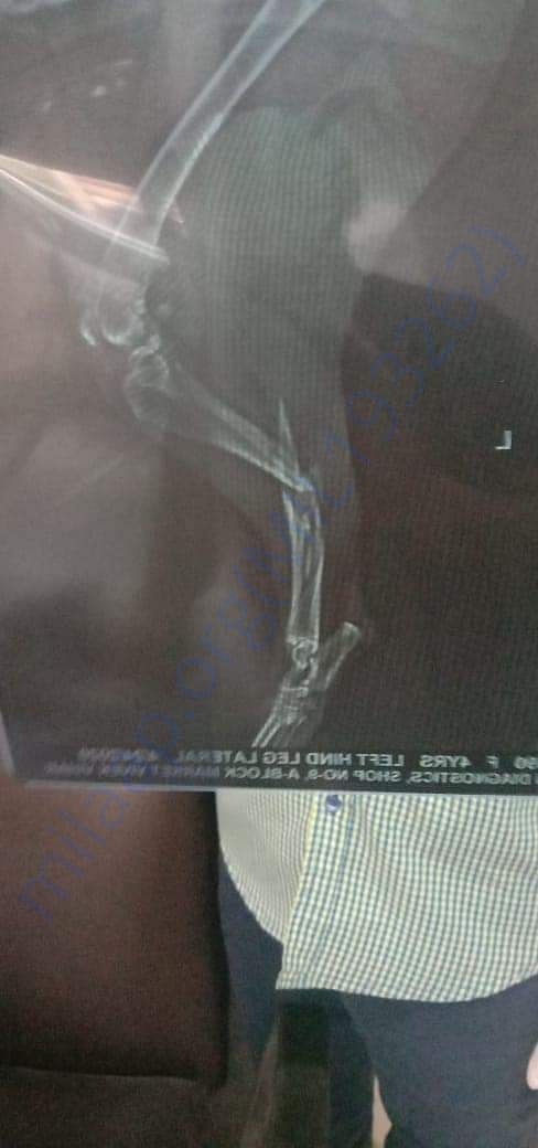 Kali Accident Case- X ray Report