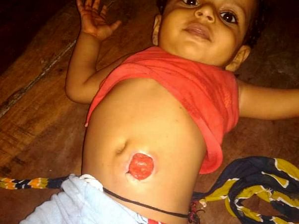 Support Kunal Kumar to recover from Anal atresia