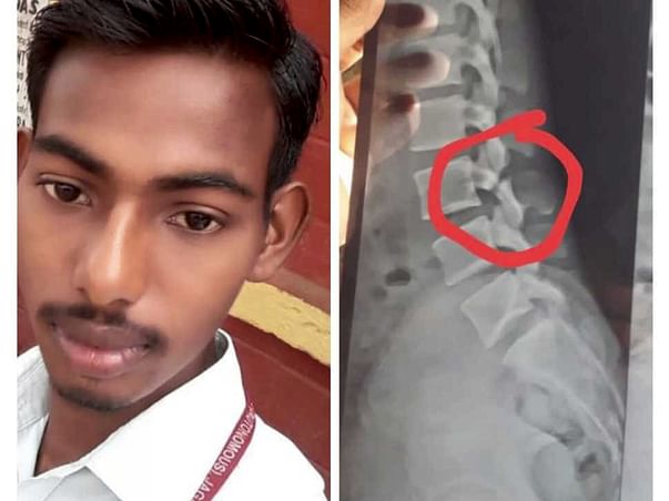 I’m struggling with Post traumatic spinal cord injury, help me
