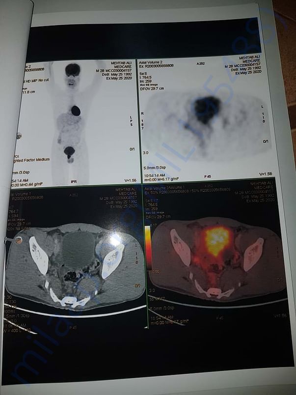 Cancer report