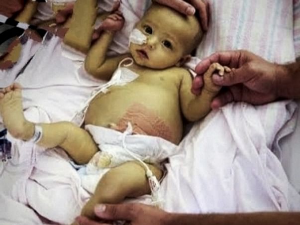 Baby Parul needs urgent Liver Transplant within 30 days
