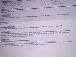 Help my mother to fight stomach cancer
