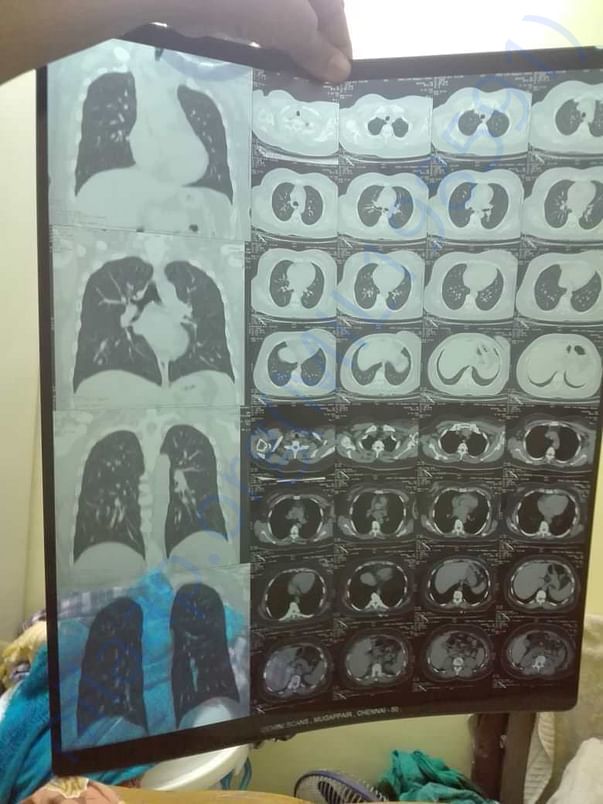 CT scan
