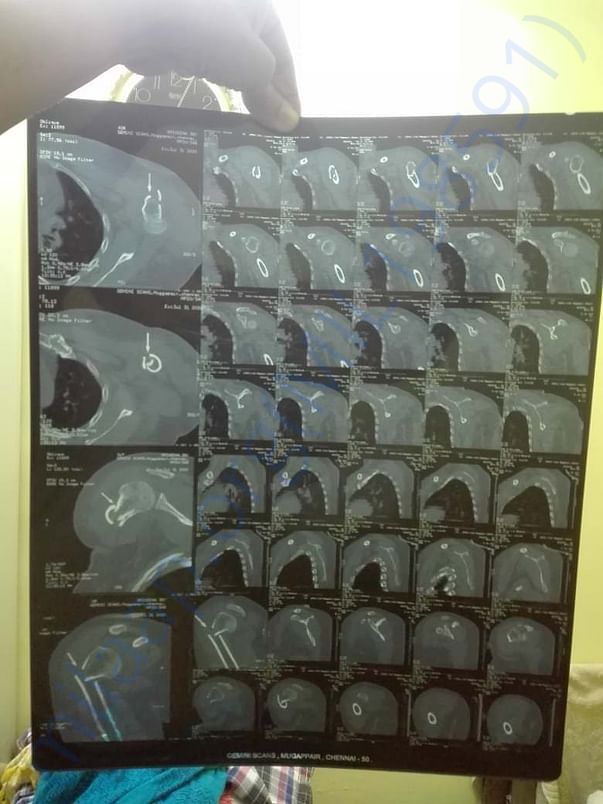 CT scan