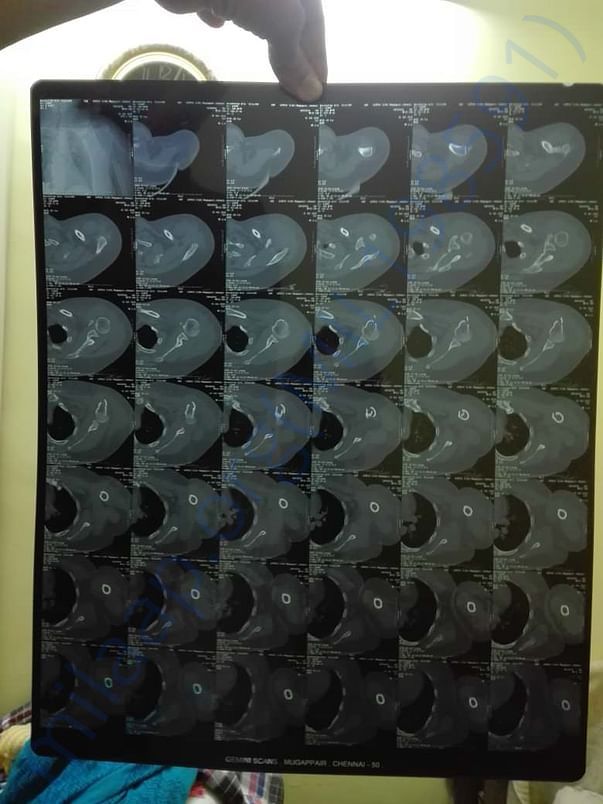 CT scan