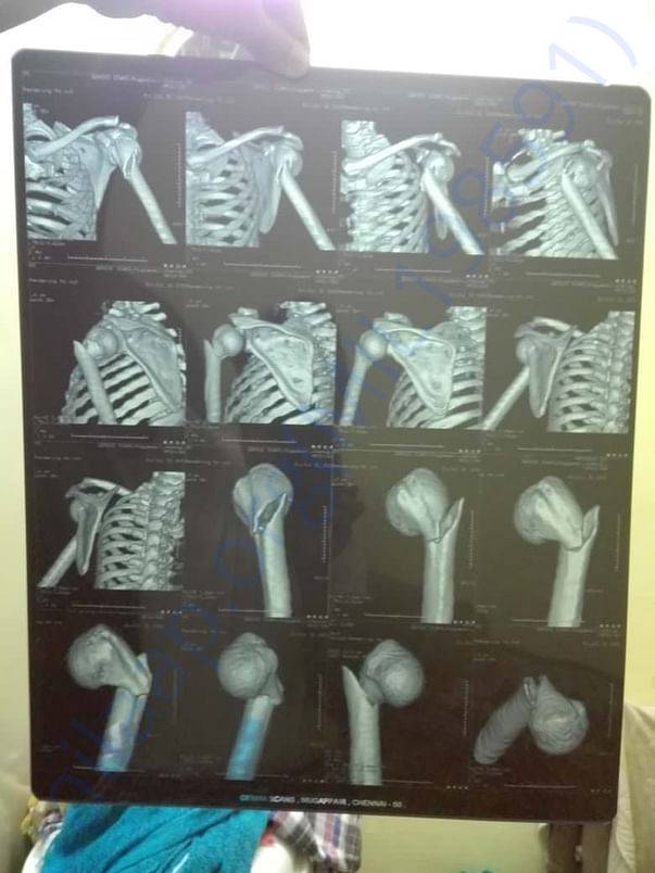 CT scan
