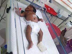NO INCOME PARENT,Baby of Ms.Abirami fight Meconium aspiration syndrome