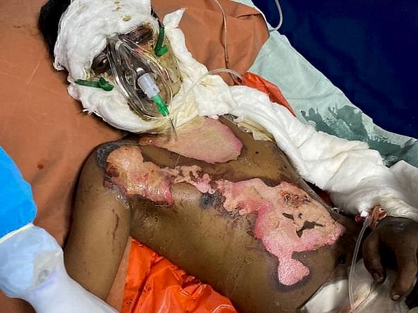 Please this 18years old boy Ajaz Fight Burns