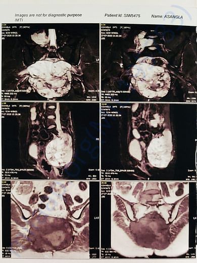 MRI Pelvis 2