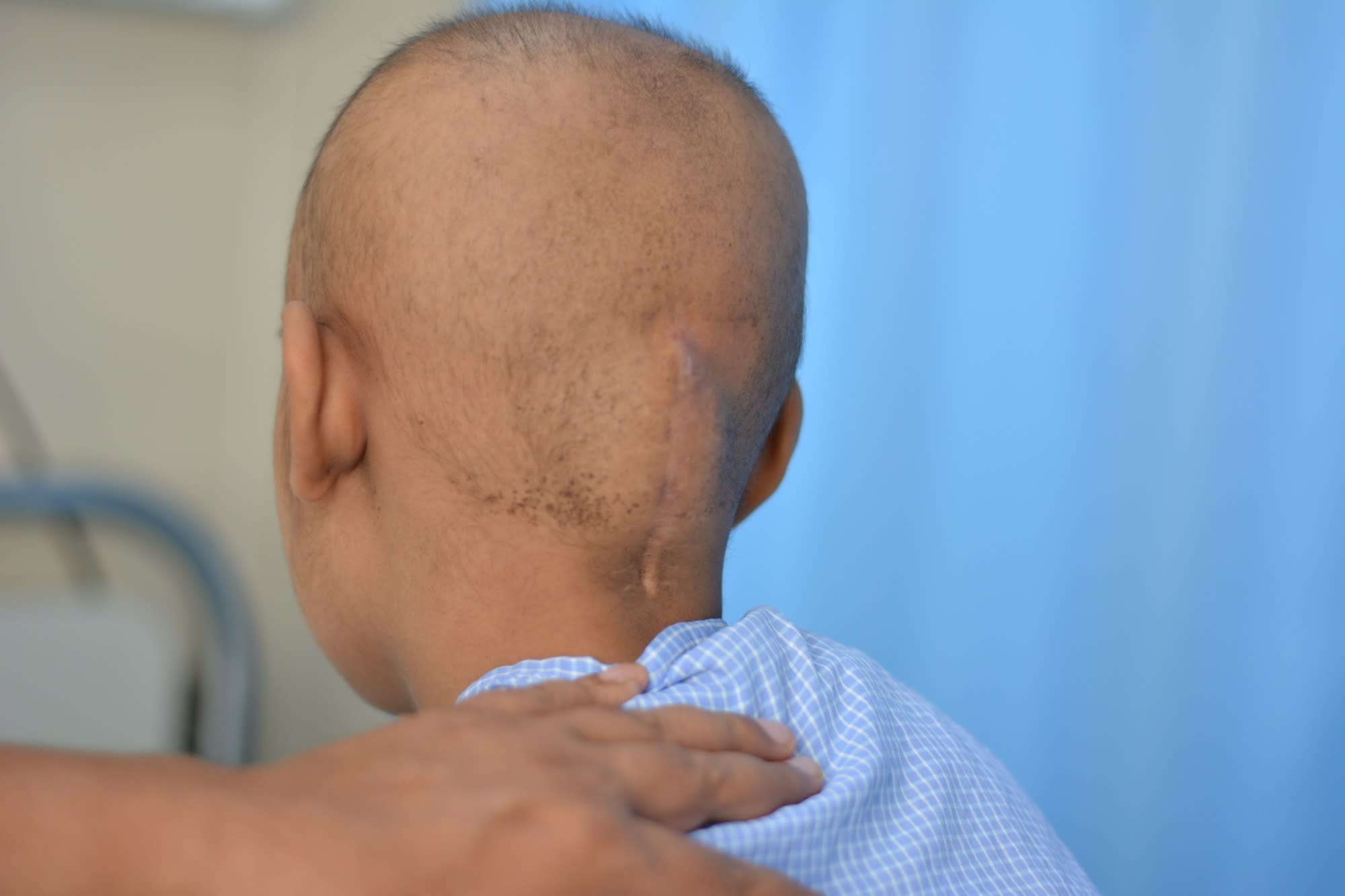 Tumour In This Boy's Brain Made Even Blinking Extremely ...