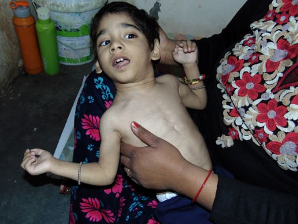 Help 4 yr old Anmol to survive and live a normal life