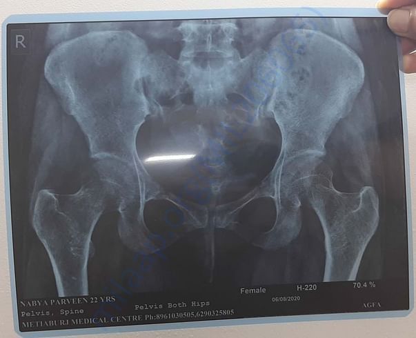 X ray