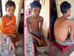 Help Mathew fight his sickness "Edema"swelling of body