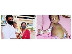 1 Year Old Aswin Needs Your Help In Fight For Liver Faliure And Needed Liver Transplant