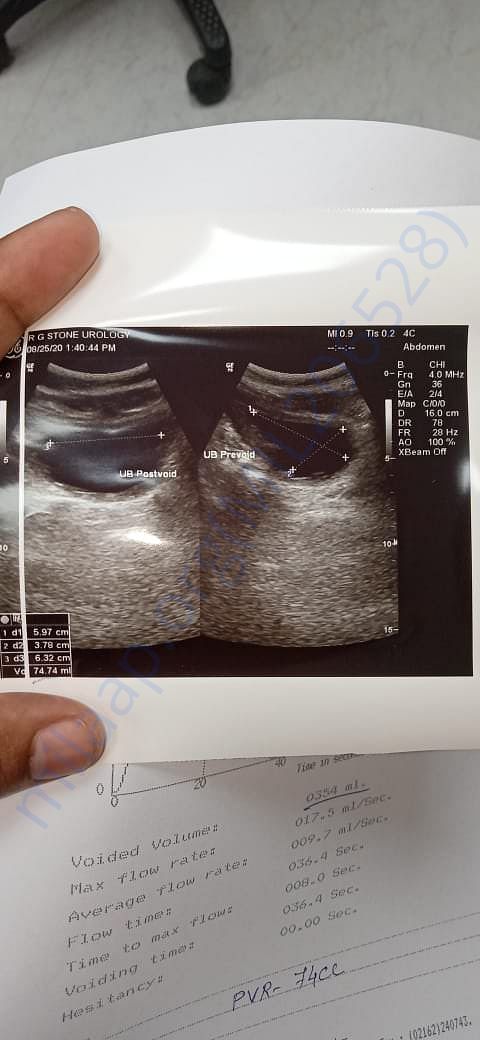 My kidney size
