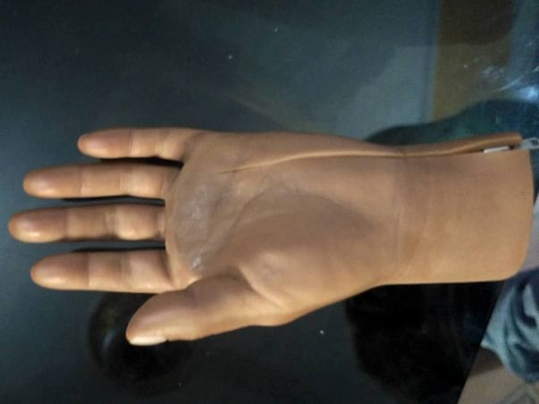 Support Rohit to raise funds for a Prosthetic Hand
