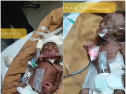 Help my daughter for NICU care who born as twins and now become one.