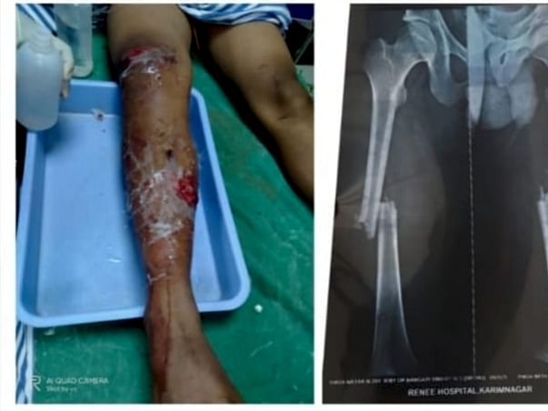 Support Shiva Nayak Recover From Accident