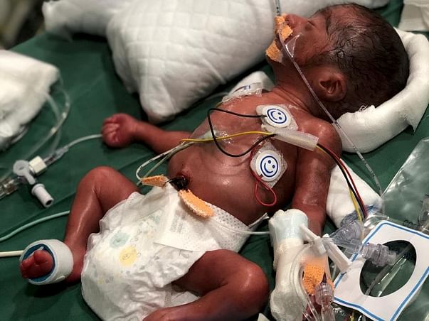 Help Critical Pre Term Baby Boy admitted in NICU