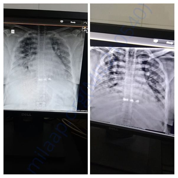 Scan of Lungs Showing Critical Condition ( DAY 3 & DAY 10 )