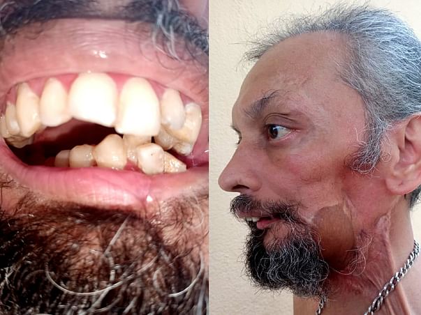 Help Pradeep For His Jaw Reconstruction Surgery