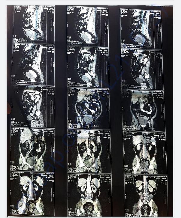 Ct scan