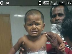 Please Help My Nephew from Severe Burn