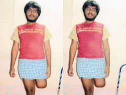 Help Vijay replace his Amputated leg