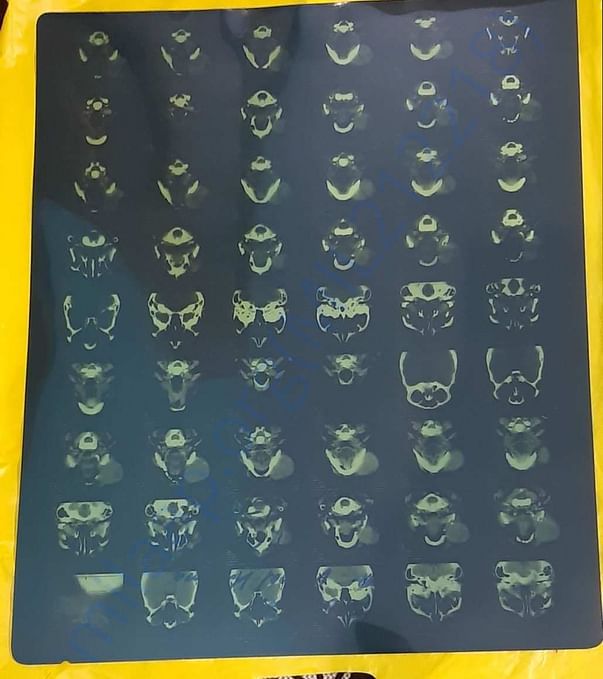 CT Scan