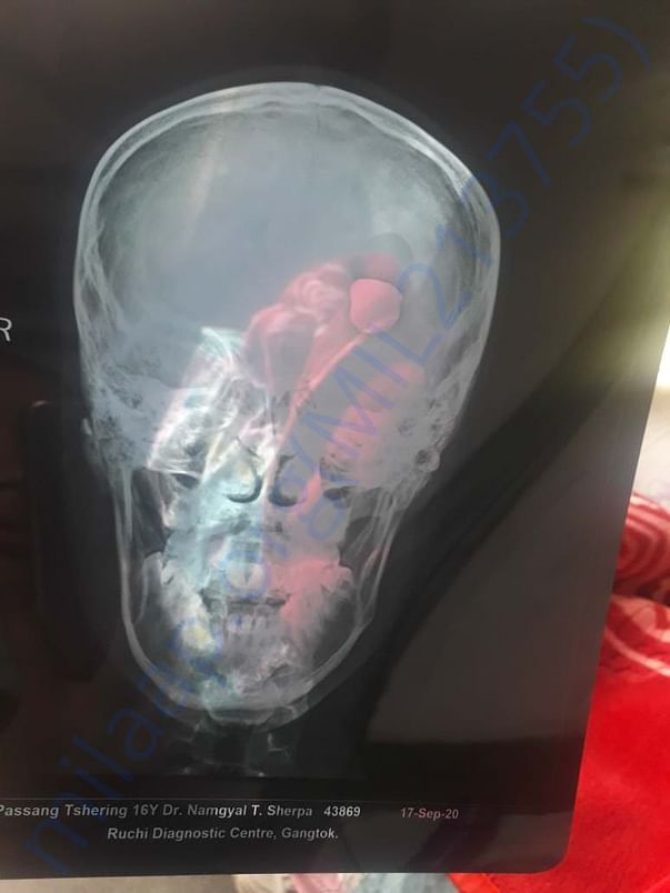 CT scan