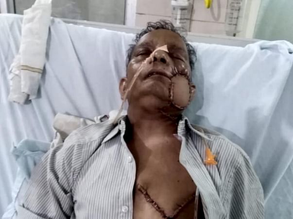 Help Mr suresh kumar gupta for treatment of oral cancer