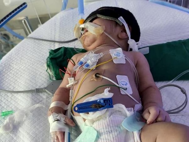 Support Baby of Kudipudi Sai Devi fight/recover from high risk Arterial Switch VSD surgical Closure and COA Repairs