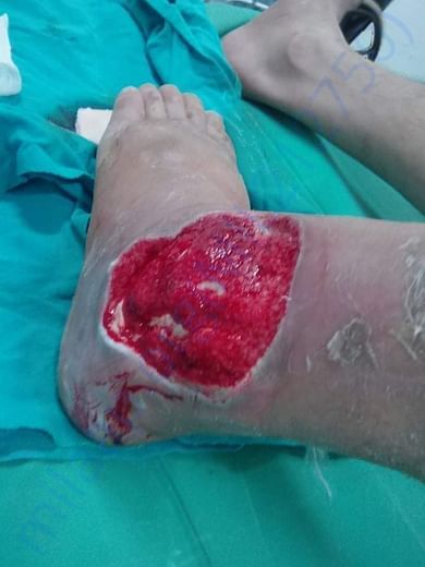 Infection and needs skin grafting