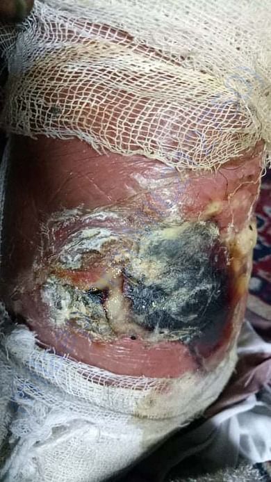 Wound worsening due to infection