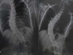 My Sister Needs Your Urgent Support In Fighting Scoliosis