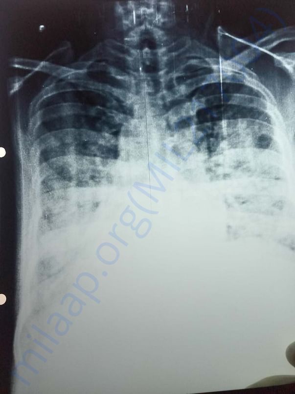 Xray