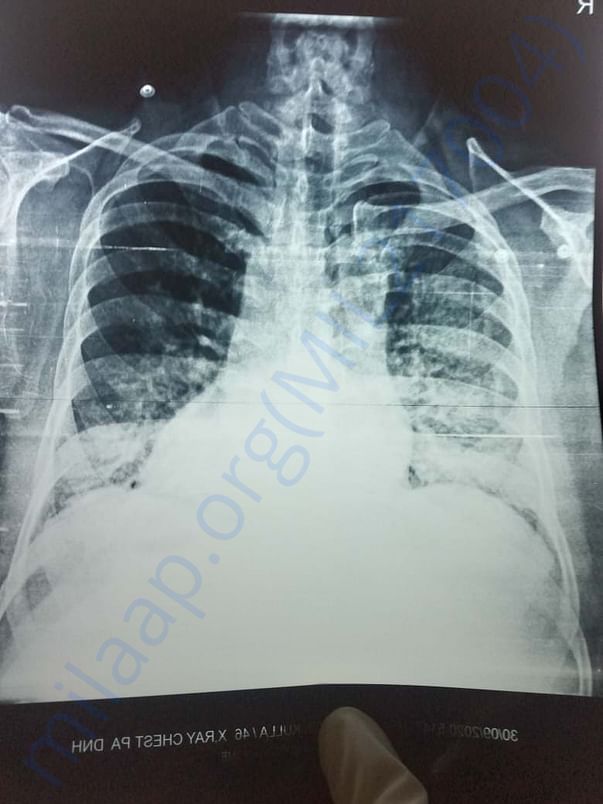 Xray