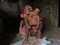 Conjoined Twins Need A Surgery To Live A Normal Life