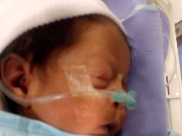 Baby fight nerve weakness and breathing problem